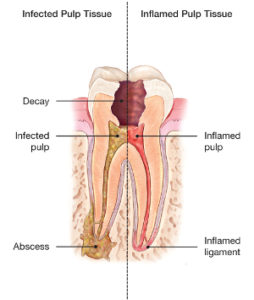 abscessed tooth