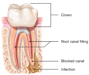 endodontic retreatment root-canal